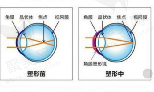 角膜塑形镜的利与弊