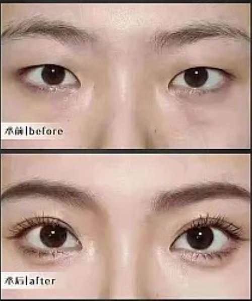上海美莱整形双眼皮技术怎么样