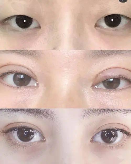上海美莱整形双眼皮术后评价
