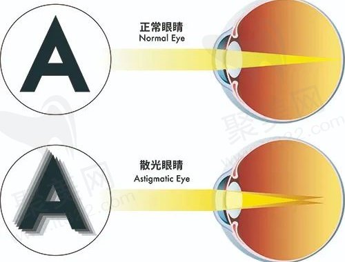 散光500度可以做激光手术吗