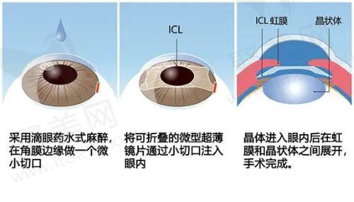 北京华德眼科医院近视手术怎么样