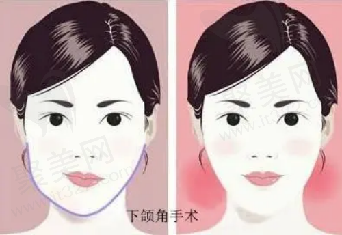 武汉下颌角磨骨费用