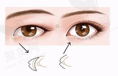 北京张冰洁修复内眼角怎么样 北京张冰洁修复内眼角怎么样