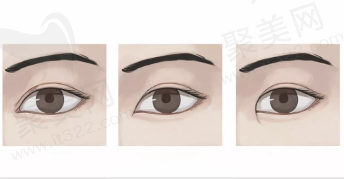 修复内眼角会留疤痕吗 修复内眼角会留疤痕吗