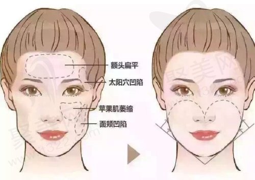 做面部轮廓固定需要多少钱