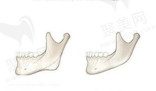 罗恩医生做下颌角手术优势