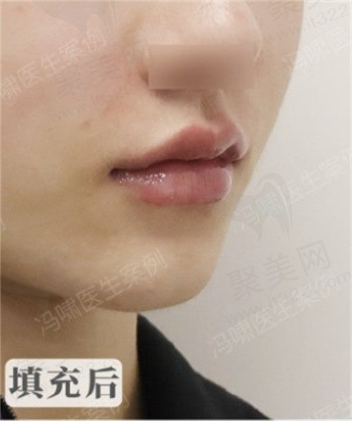 冯啸医生打嘴巴玻尿酸