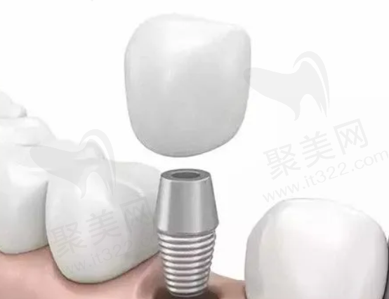 半口种植牙什么意思