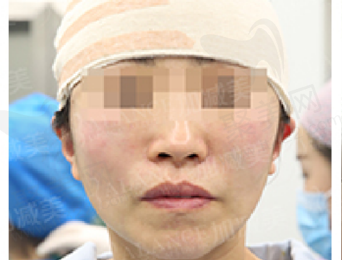 北京加减美黄寅守做拉皮怎么样