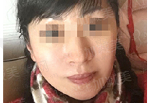 北京加减美黄寅守做面部提升怎么样