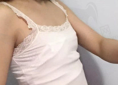 隆胸手术后的恢复过程