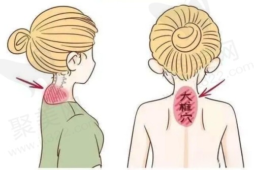 富贵包吸脂好还是手术切除好