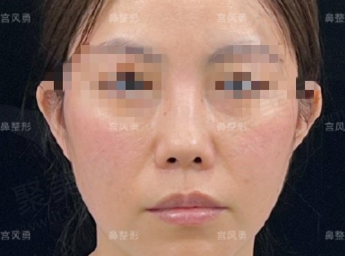 北京宫风勇医生隆鼻技术很棒