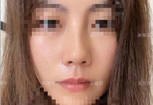 北京宫风勇医生隆鼻技术价格