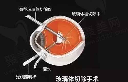 玻璃体切割术风险大吗？