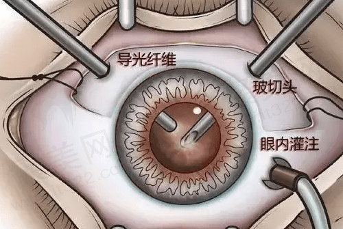 什么是玻璃体切割术？