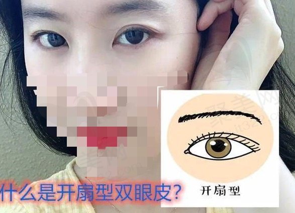 开扇双眼皮真人实例图
