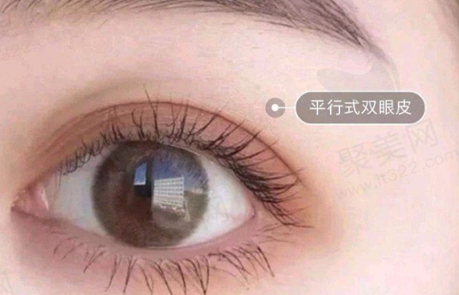 双眼皮是选择平行好还是开扇好？