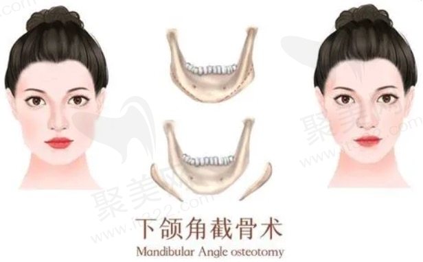 如果下颌角截骨后的增生问题怎么办