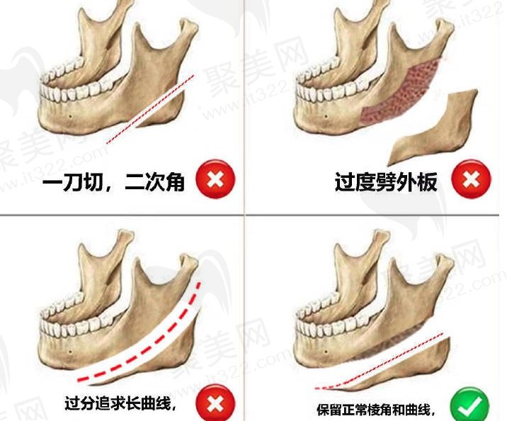 下颌角手术风险有多大