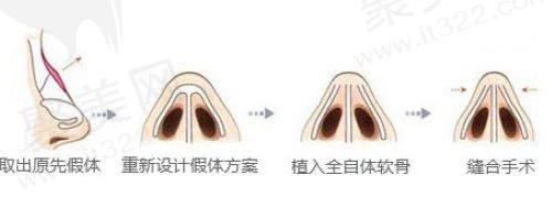 鼻修复步骤