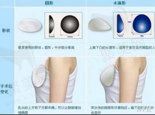 假体隆胸材料形状区别