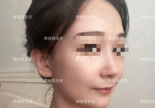 西安师俊莉做鼻子价格