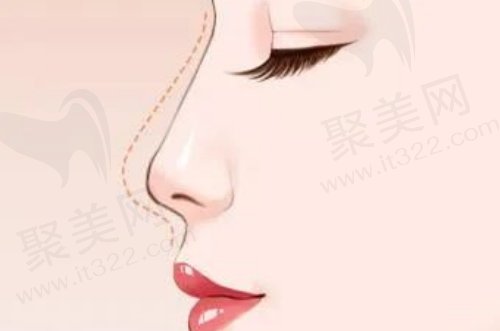 射极峰膨体隆鼻的优势
