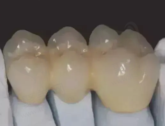 全瓷牙和烤瓷牙哪个好
