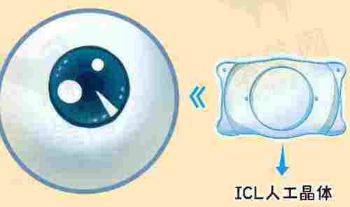 ICL 人工晶体
