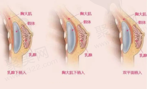 杭州维多利亚刘中策医生隆胸怎么样