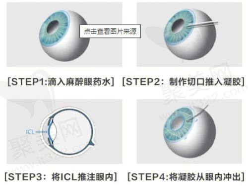重庆佰视佳眼科赵小虎做近视手术怎么样