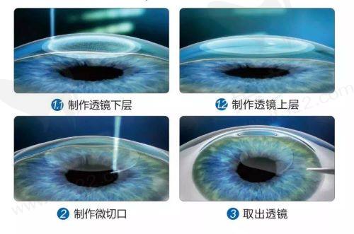重庆何氏眼科李付亮做近视手术怎么样