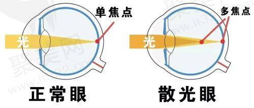 近视加散光使用激光治疗的要求