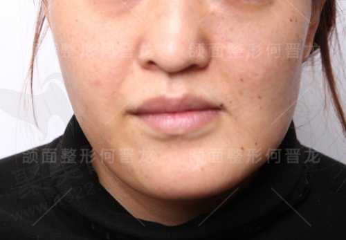 找时光整形何晋龙做正颌