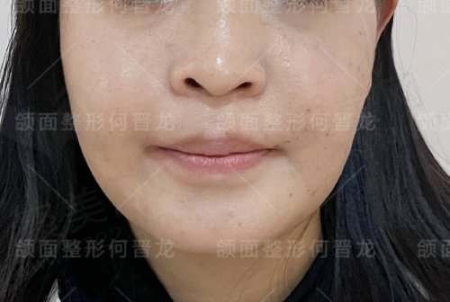 上海时光何晋龙做正颌病例