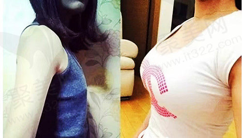 南京美莱隆胸前后