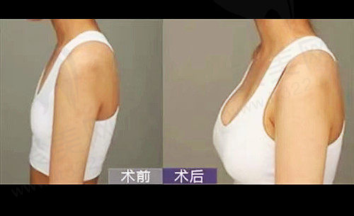 南京美莱隆胸对比