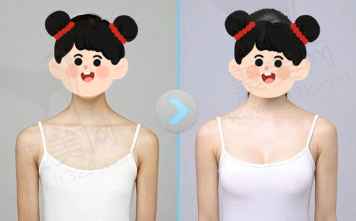 南京美莱隆胸经历