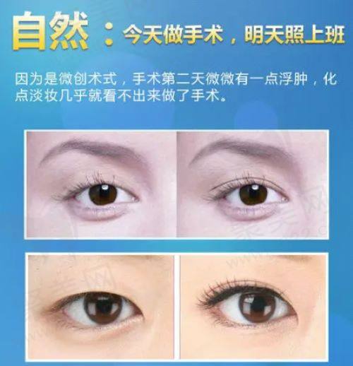 上海华美侣同帅做双眼皮技术怎么样 上海华美侣同帅做双眼皮技术怎么样