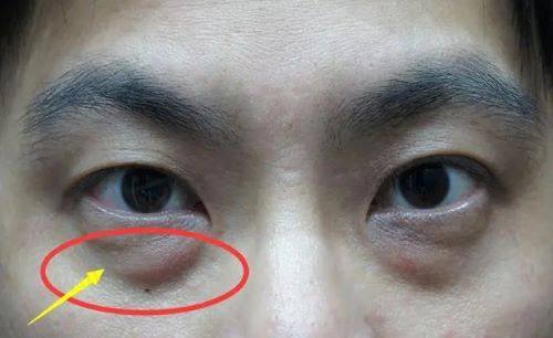 怎么去除眼袋