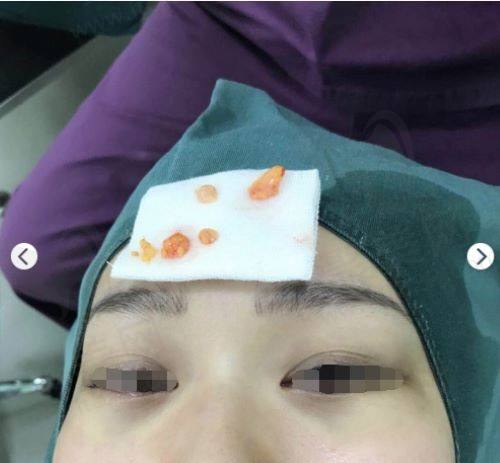 吸脂去除眼袋
