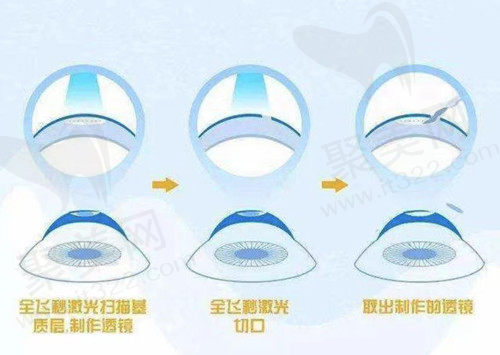 全飞秒手术的步骤