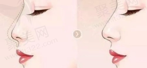 上海华美叶丽萍做鼻子价格 上海华美叶丽萍做鼻子价格