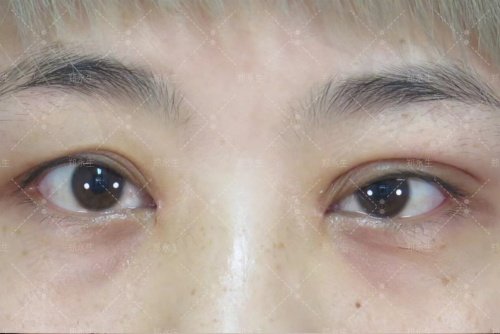北京郑永生做双眼皮修复怎么样 北京郑永生做双眼皮修复怎么样