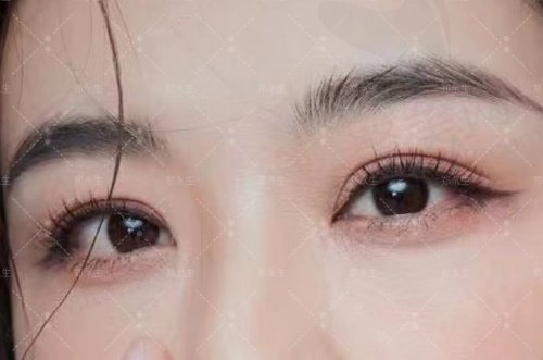北京郑永生做双眼皮修复怎么样 北京郑永生做双眼皮修复怎么样