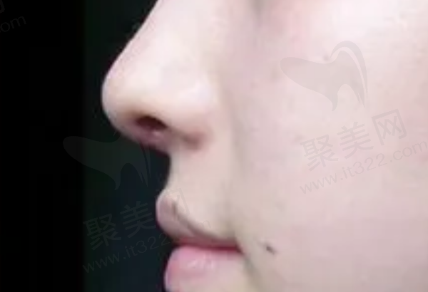 襄阳华美整形美容医院隆鼻技术怎么样