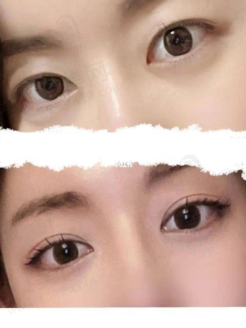 昆山嘉美奥医疗美容诊所张之霖做双眼皮怎么样