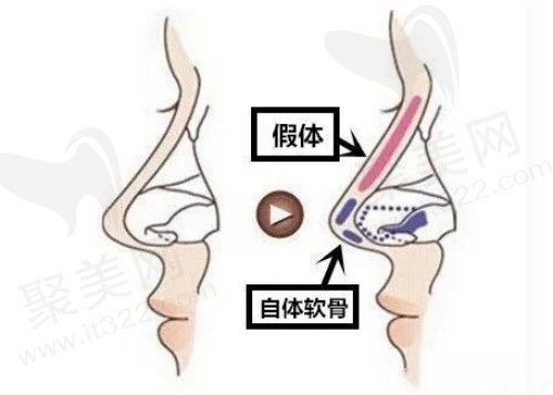 半肋骨鼻和全肋骨鼻的区别