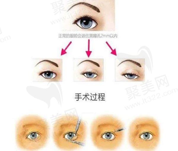 上脸提肌对比图